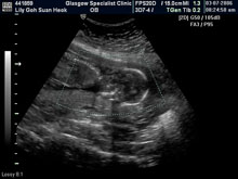 Vivian Sonograms